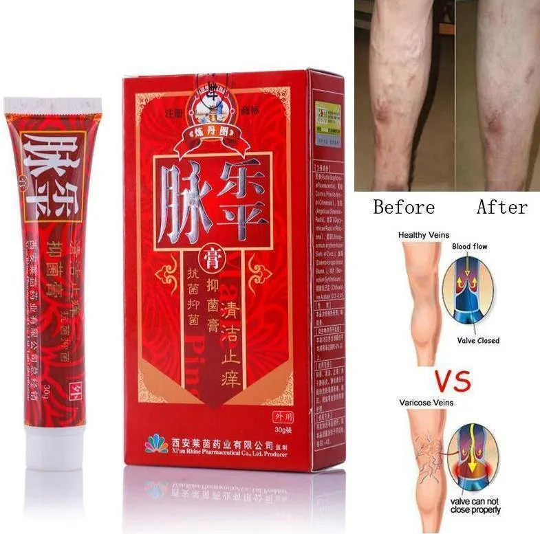 Varicose Veins Treatment Cream